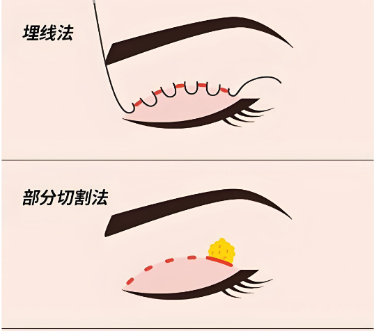 广州冯传波双眼皮手术前后对比照片