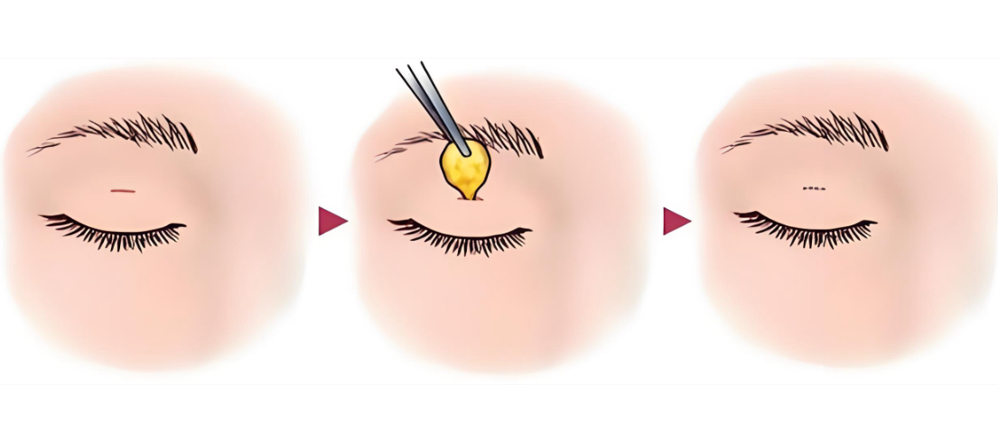 广州冯传波双眼皮手术