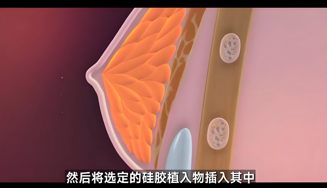 广州李文峰做隆胸怎么样