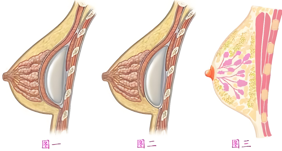 广州李文峰做隆胸价格www.aimei.com
