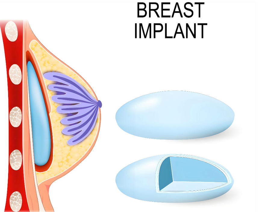 广州李文峰做隆胸好不好
