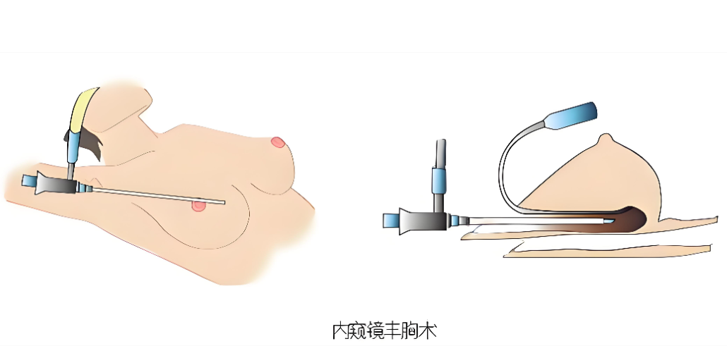 广州郭震宇自体脂肪隆胸靠谱吗