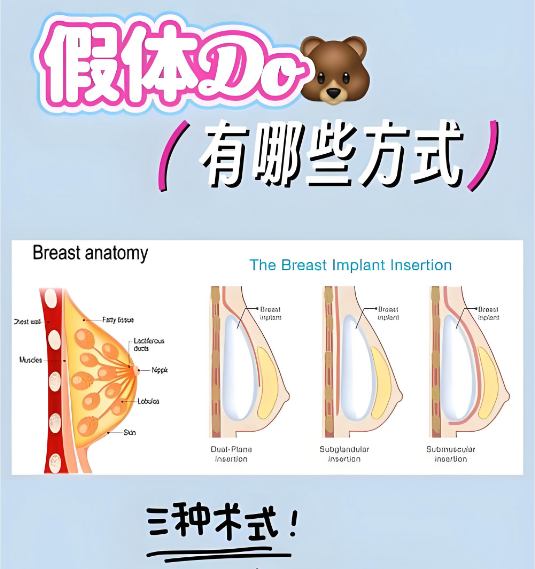 广州郭震宇自体脂肪隆胸