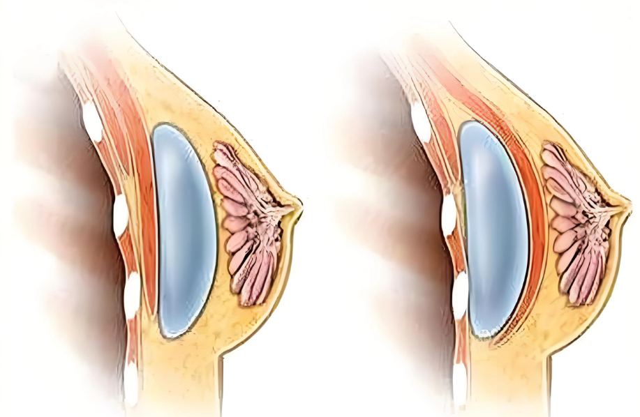 广州郭震宇自体脂肪隆胸价格www.aimei.com