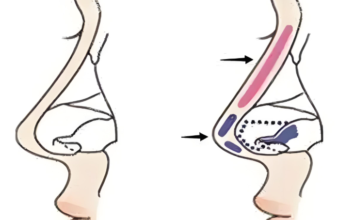 全新版南京隆鼻价格表:其中假体隆鼻4900元起含优质医院收费参考