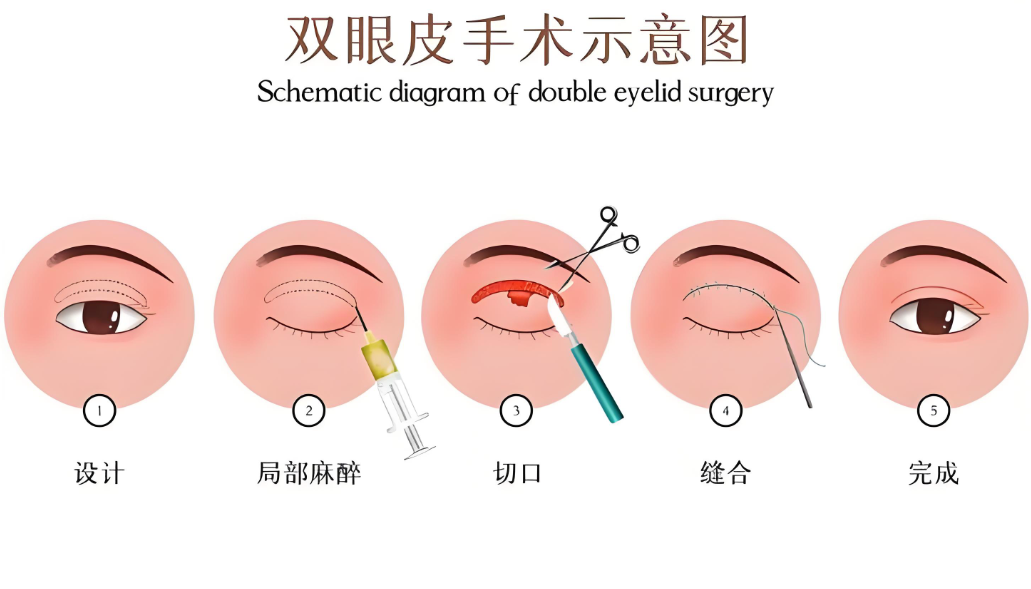 冯传波双眼皮手术会不会有内置线？这个问题我也担心过，拆线时特意看过伤口，没有多余的线