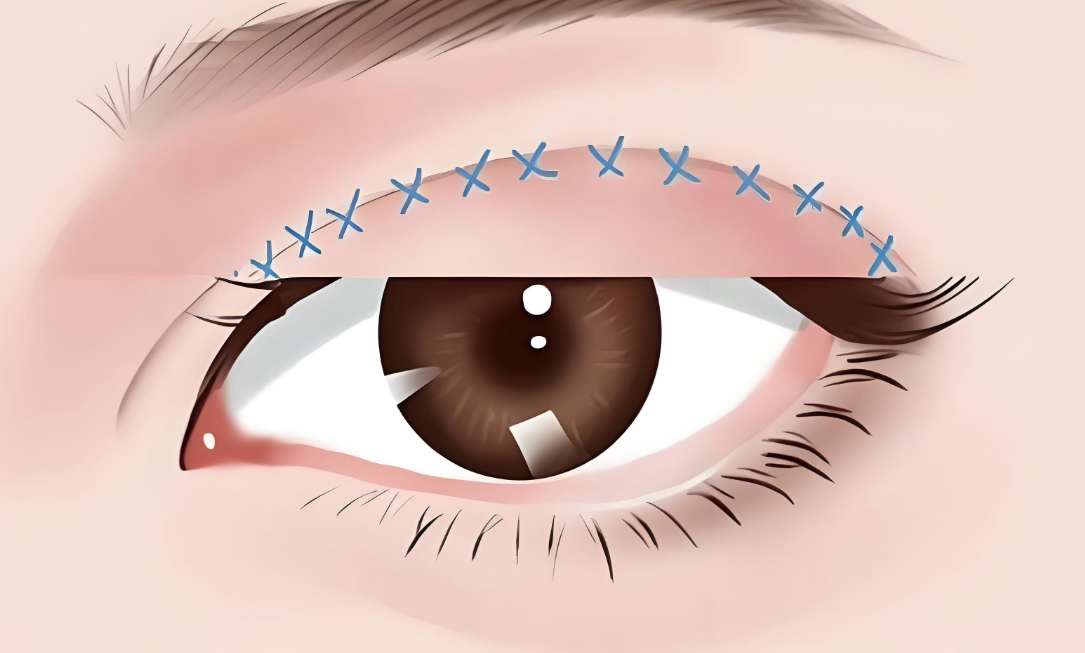 冯传波双眼皮手术好不好www.aimei.com