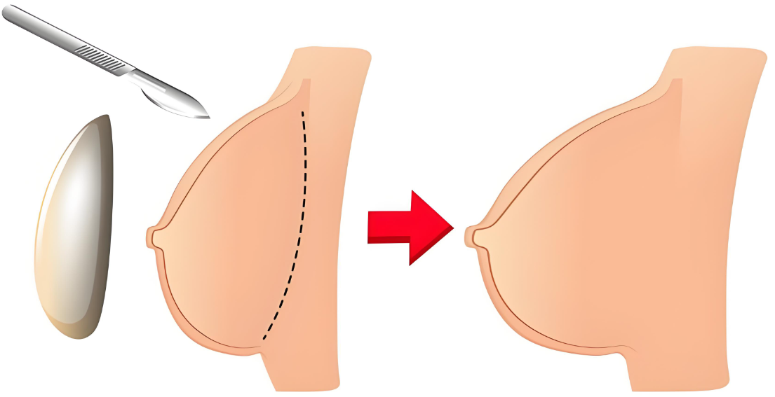广州冯传波隆胸怎么样？我做完快一年了，现在手感软软的，自己也觉得挺自然