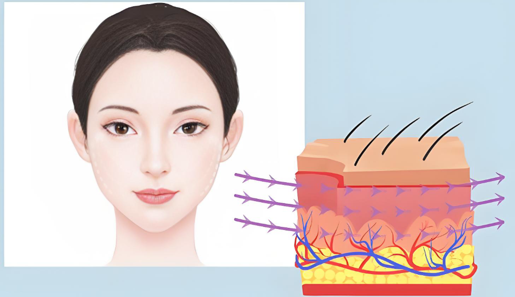 广州黄广香面部提升技术怎么样？我只能说，她做的提升，功效真的藏在细节里