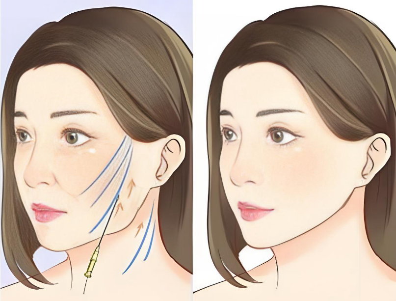 广州黄广香面部提升www.aimei.com