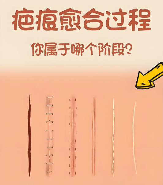 兰州维多利亚祛疤怎么样