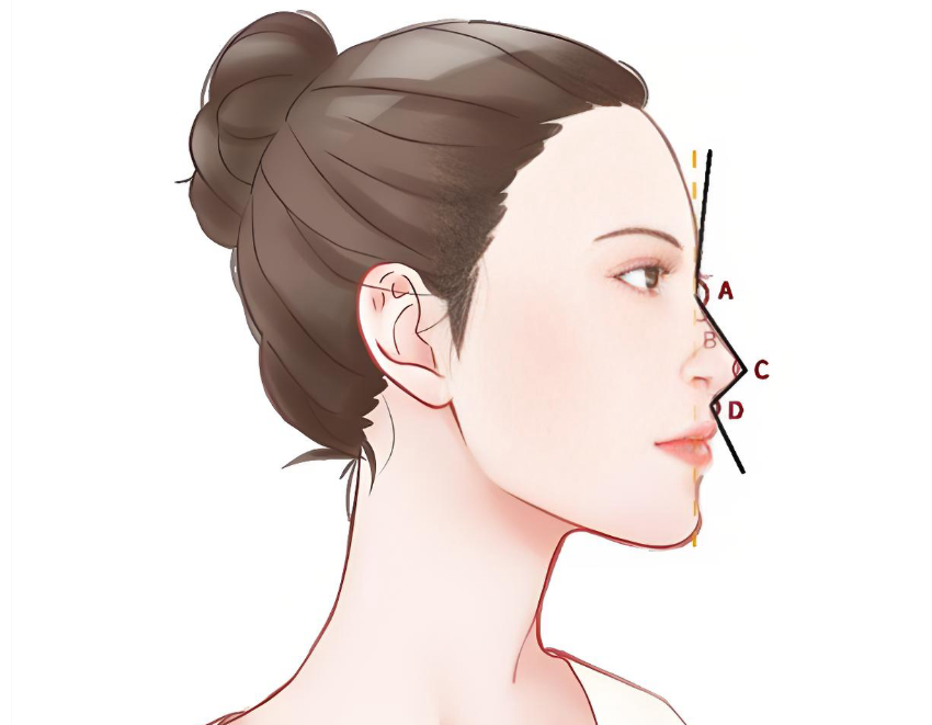 广州高顺福修复鼻子实例流出:硅胶取出换肋软骨,鼻尖终于不再刺痛发红