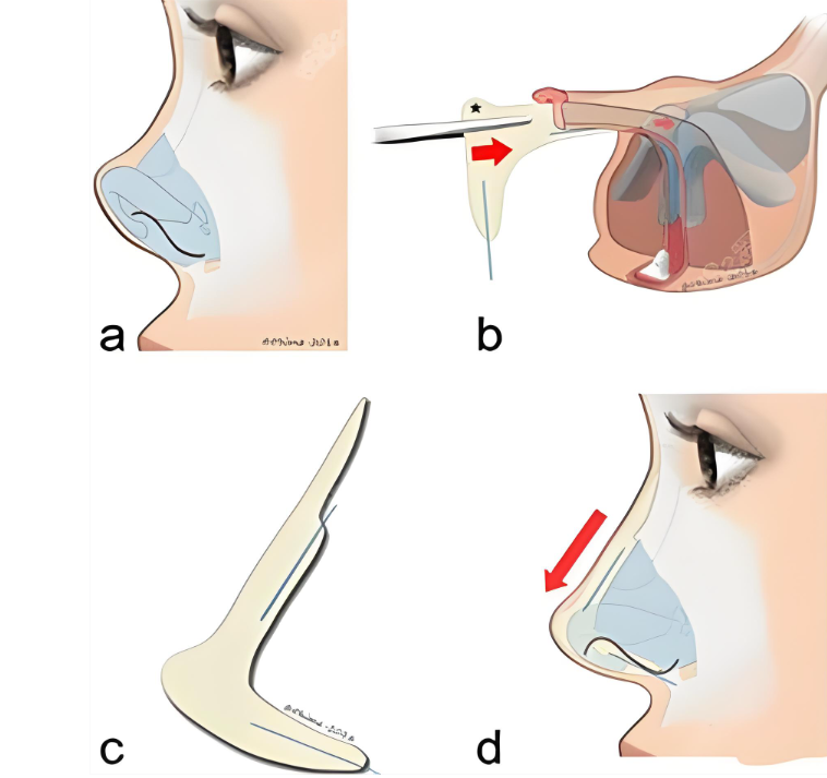 广州高顺福修复鼻子怎么样