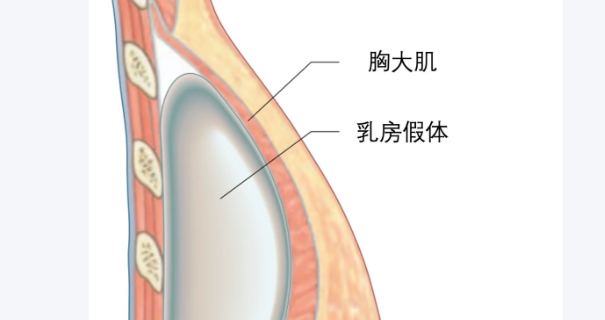 苏州维多利亚隆胸假体取出技术如何?隆胸范例看其技术实力与服务体验