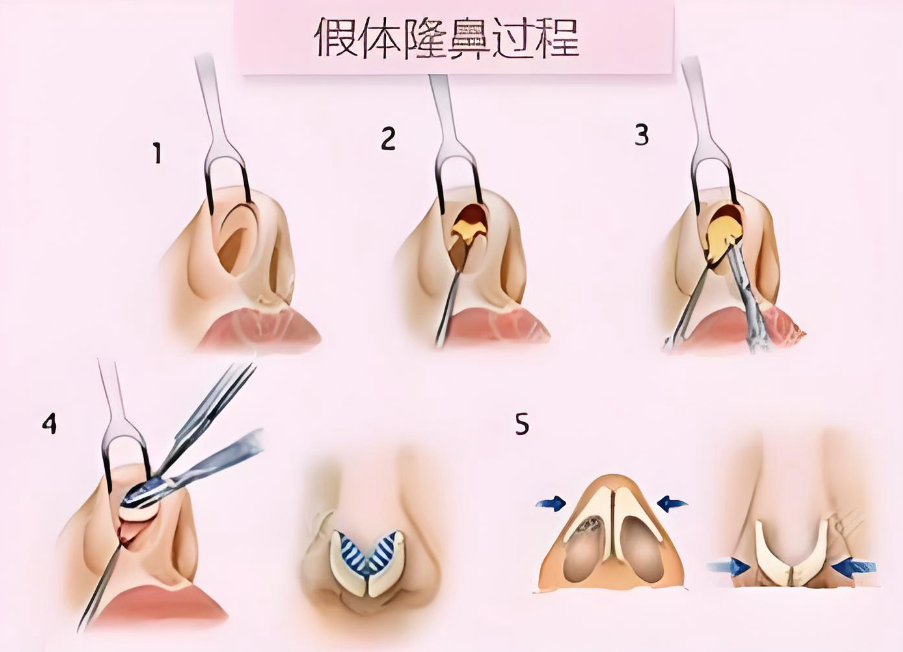 东莞鼻综合医院哪家好www.aimei.com