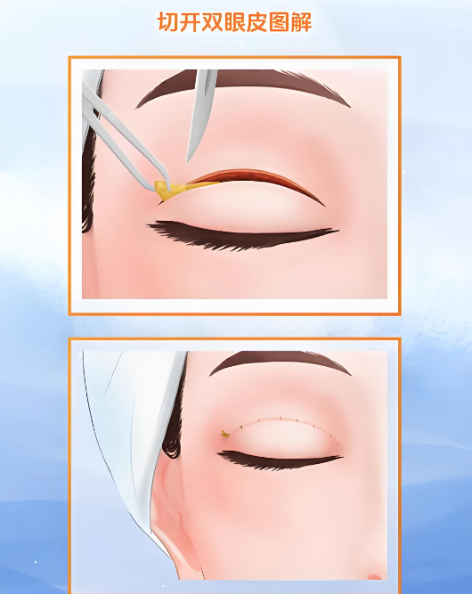 赶紧码住!广州割双眼皮医生推荐排名前十,附各医生特点和预约方式!