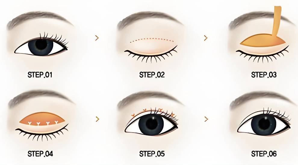 广州割双眼皮医生推荐