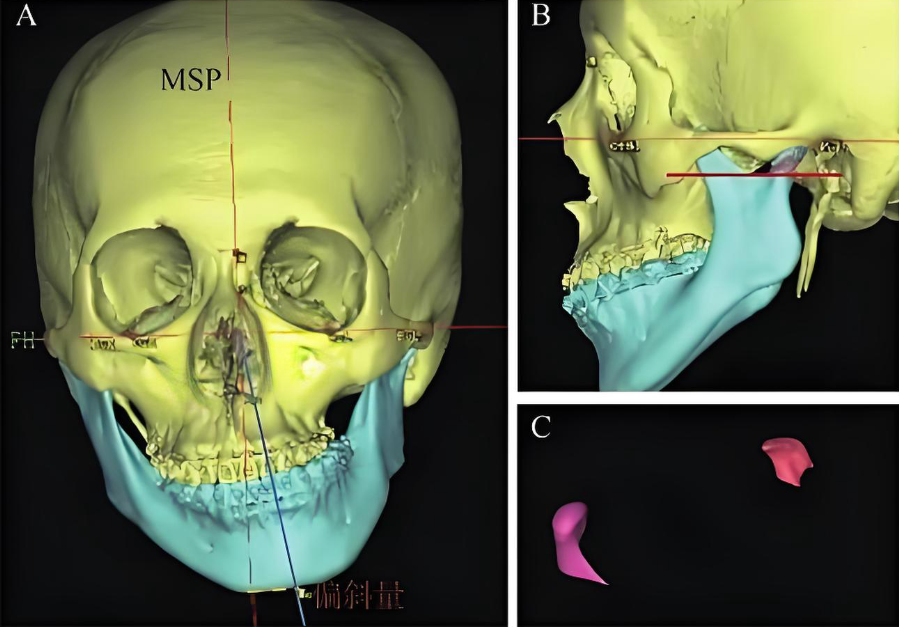 何锦泉做嘴巴突出骨性双颌手术吗？答案是肯定的，我就是在他那做的凸嘴矫正