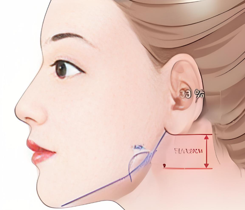 何锦泉做嘴巴突出骨性双颌手术怎么样