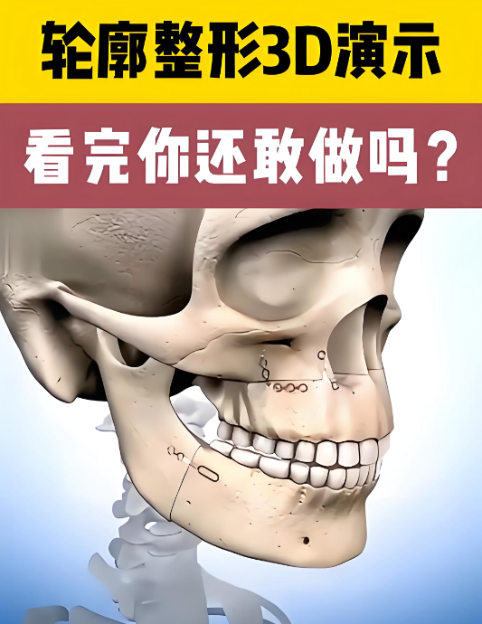 广州整形医院徐威强轮廓手术实例分享：看完这前后的骨相变化我服了