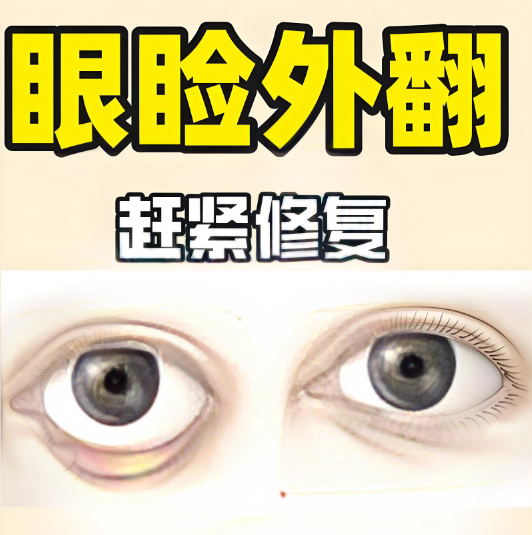 眼外翻外眦悬吊能保持多久?有人只保了两年,也有人超过了六年,大多数维持在3-4年之间