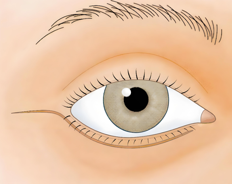 眼外翻外眥懸吊實(shí)例