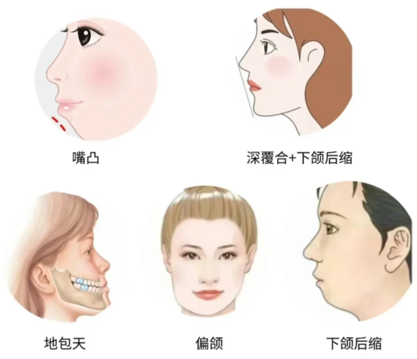 为什么成都友谊医院的正颌手术值得考虑?3D导板技术+医生团队是关键