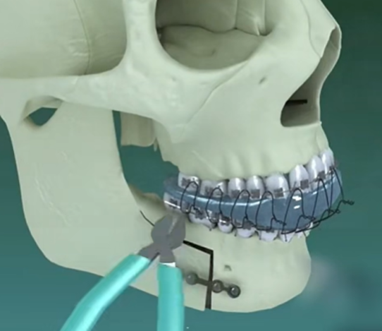 成都友谊医院正颌手术前后注意事项,这些细节别忽略!