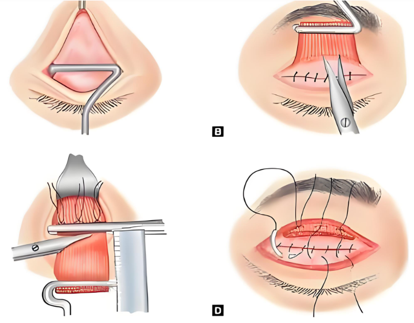 王衡健双眼皮修复技术