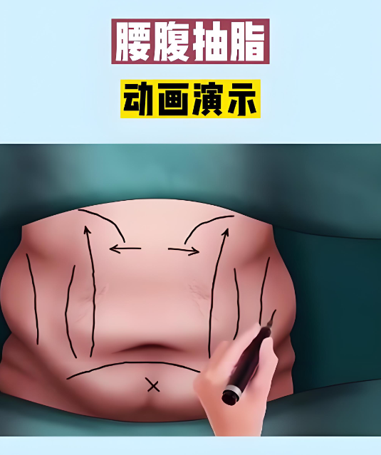 广州邓晟华抽脂怎么样?3分钟看懂他的脂肪加减法打造沙漏背,术后皮肤平整度高!