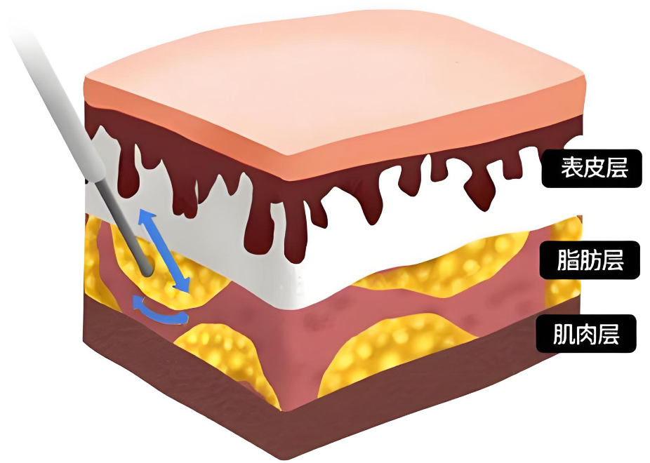 广州吸脂邓晟华好不好www.aimei.com