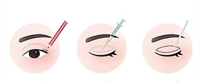 天津申伊童颜周海彦割双眼皮怎么样？技术稳定