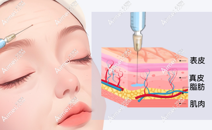 贾东宇注射示意图