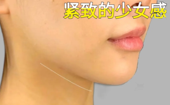 花几千做少女线提升!是交智商税还是真显年轻?实测反馈