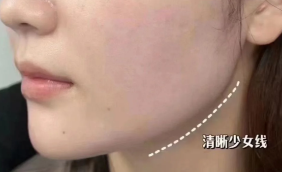 少女线提升不是智商税