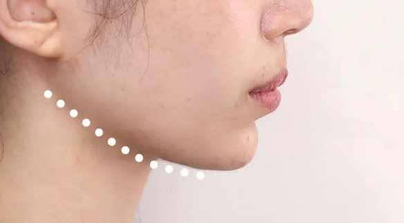 少女线提升可以管几年？埋线 / 仪器 / 注射成效维持时间对比