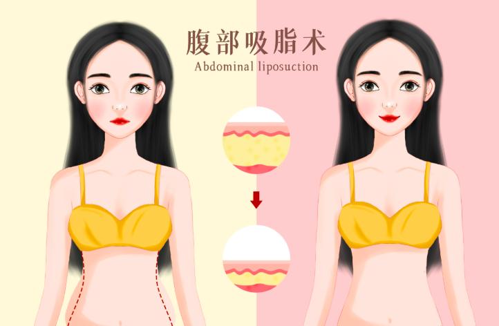 深圳钟伟洪吸脂对比图