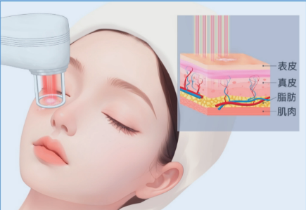 深圳联合丽格医疗美容医院点阵激光