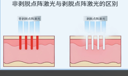 深圳联合丽格医疗美容医院点阵激光
