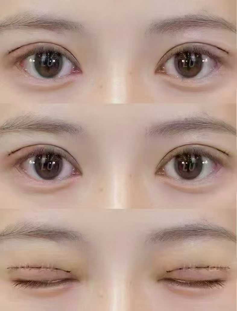 上海千美双眼皮修复哪个医生好?马娟/刘建宪/吴应凯等10位医生上榜,老患者转介绍多