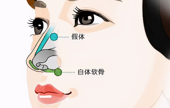 成都高培培12例鼻修复实例里，藏着3个技术关键点