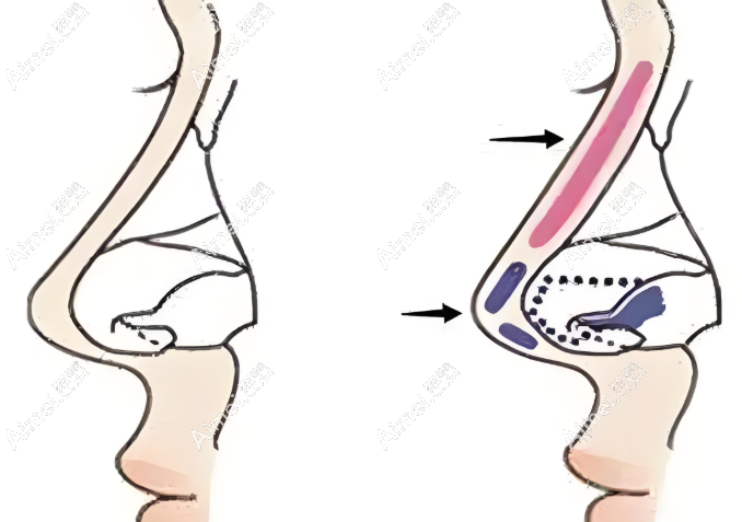 打造个性化美鼻 打造个性化美鼻