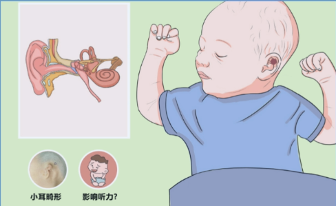 小耳畸形二期手术