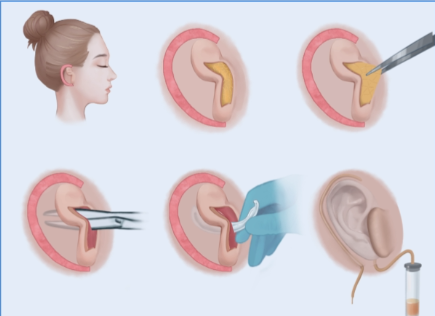 小耳畸形二期手术