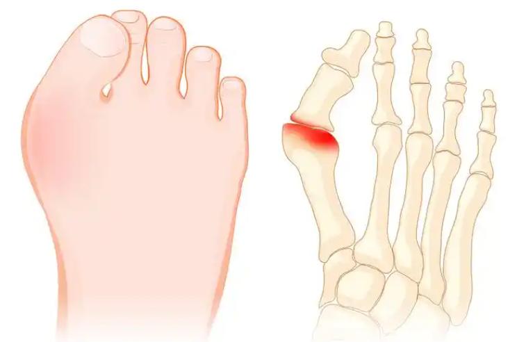 上海看大脚骨外翻哪家医院好？10家私立机构梳理，虹桥医院等5家做拇外翻用户评价好