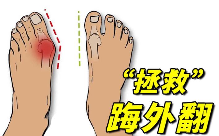 大脚骨外翻找哪家好