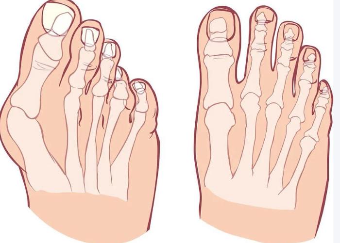 大脚骨外翻医院的用户真实反馈