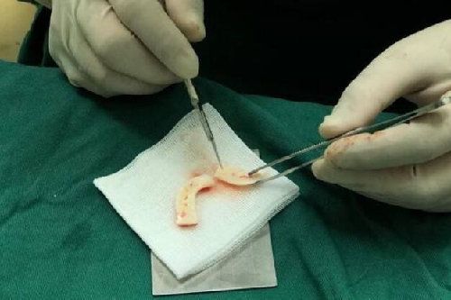 深圳张辉赫本鼻整形过程清晰