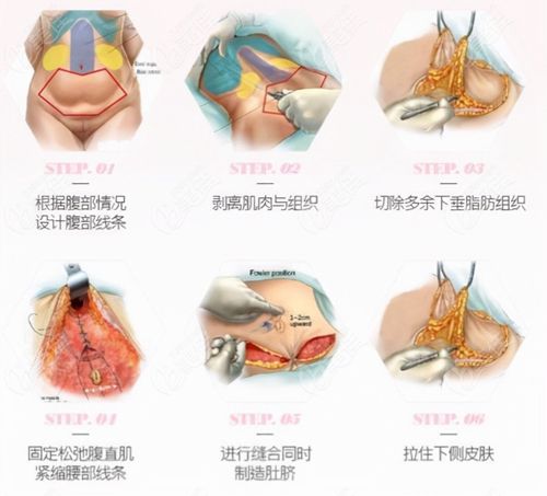国内腹壁整形好的医师前十名推荐