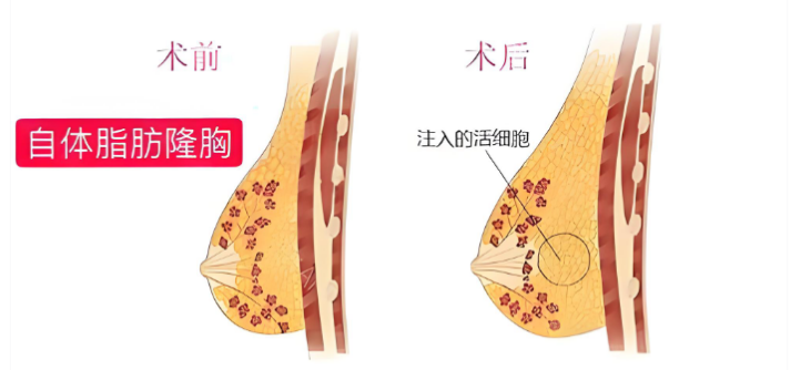 脂肪医生梁耀婵手术收费标准2025版，自体脂肪丰胸5-15万/吸脂塑形3-8万起